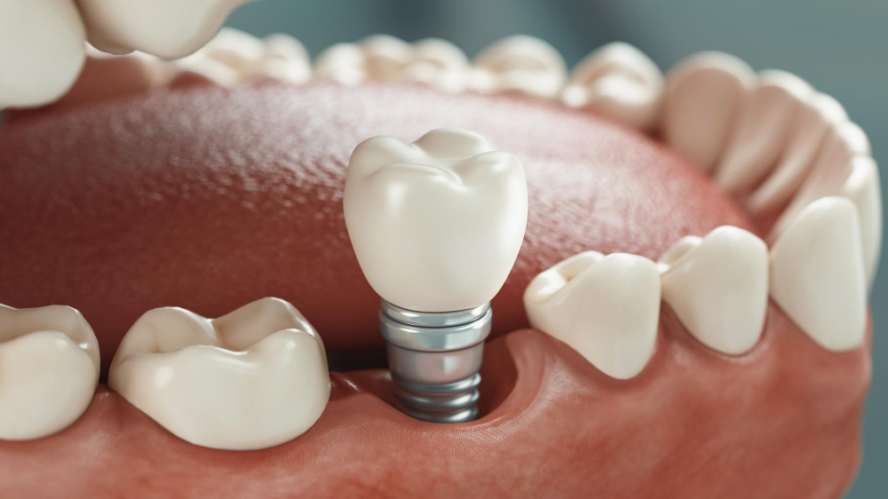 Dental Implants Saginaw, MI